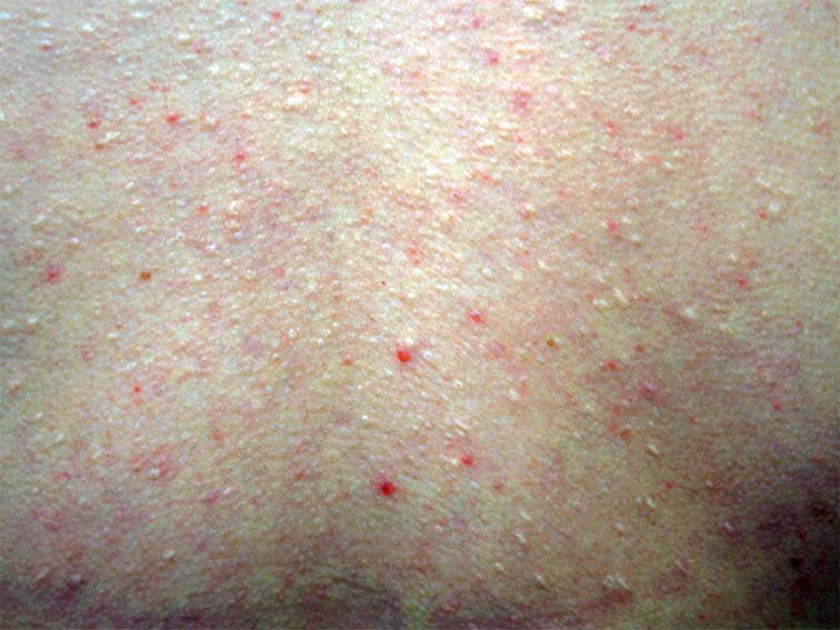 yellow spots