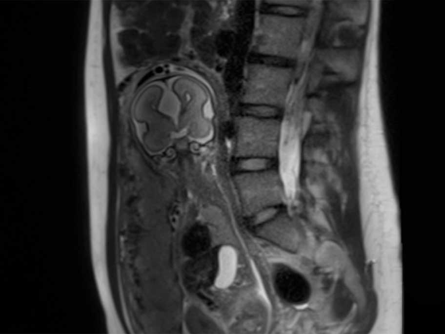 Coronal scan through the level of the frontal horns, third ventricle and sylvian fissure.