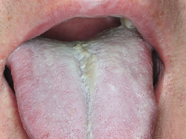 discoloured tongue