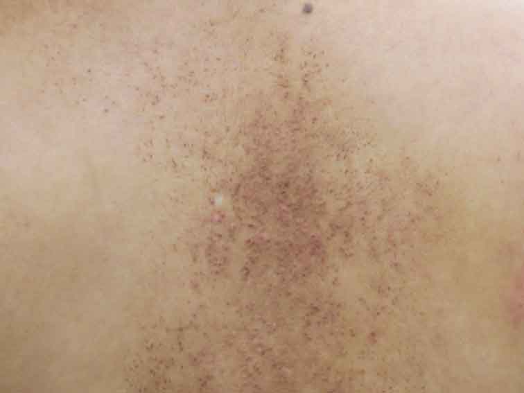 Pityriasis versicolor.