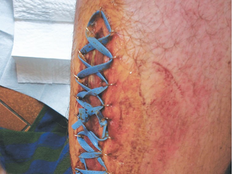 Acute extremity compartment syndrome