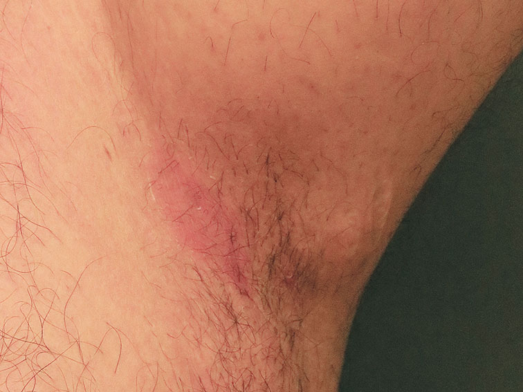 Inverse psoriasis