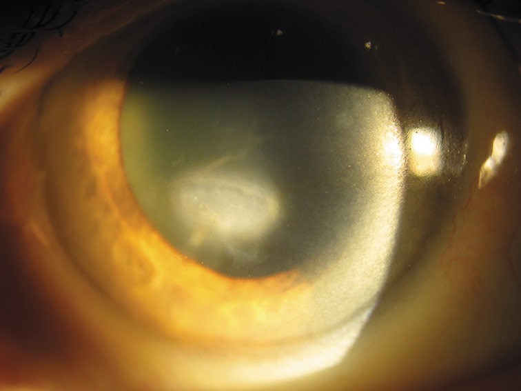 corneal scar
