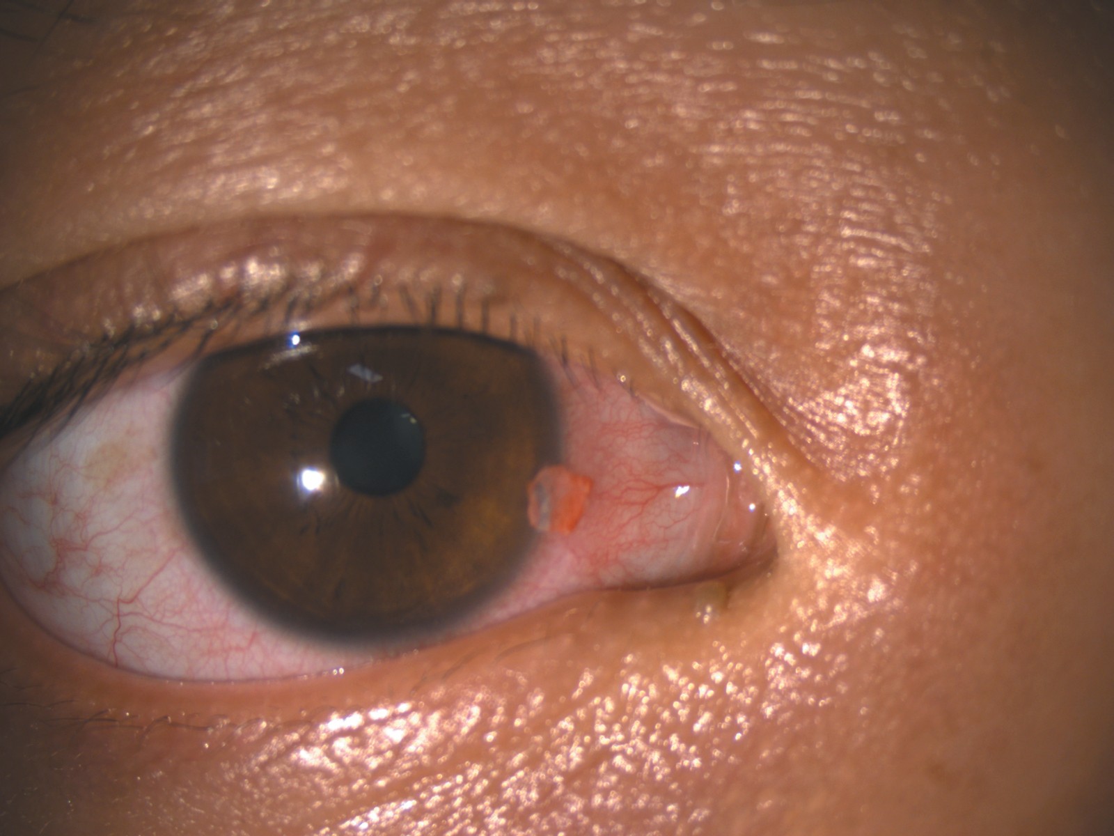 Eye foreign body