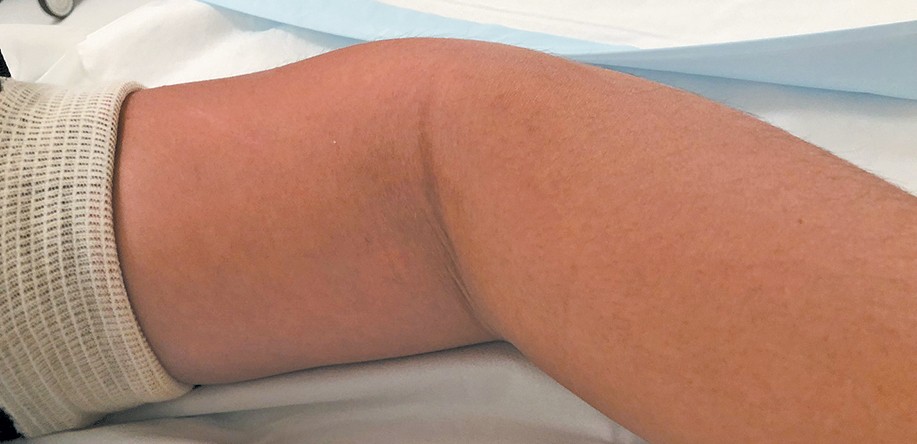 lymphangioma