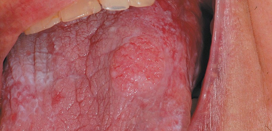 lichen planus