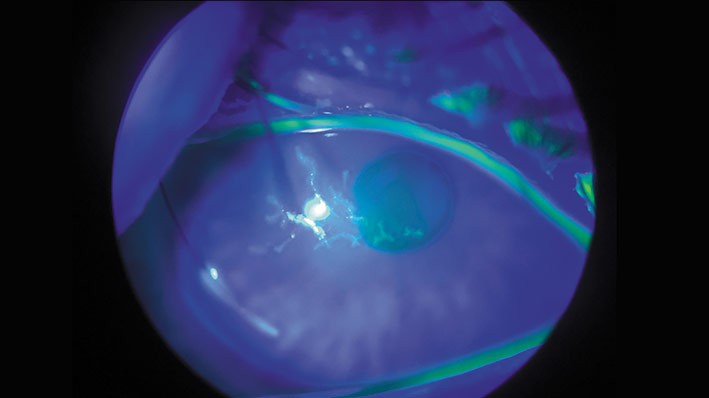 HSV eye