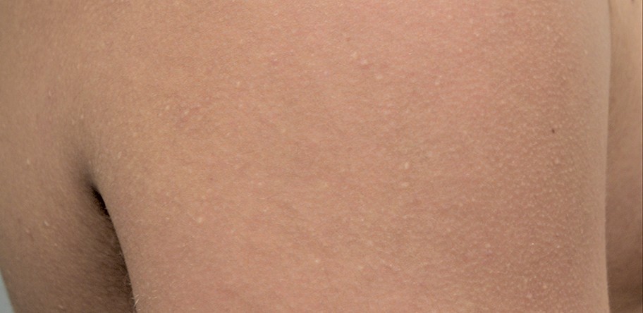 steatocystoma multiplex