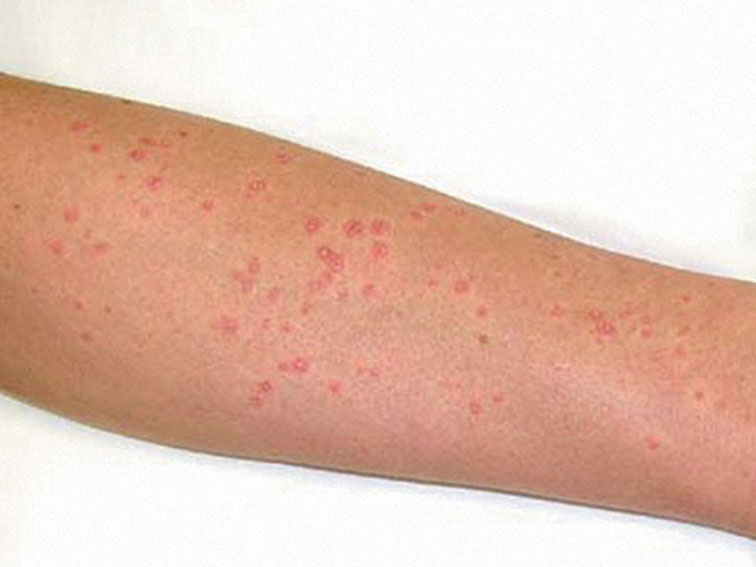 Guttate psoriasis