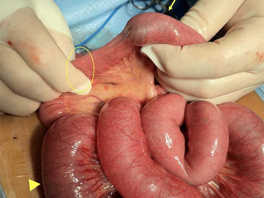 Intussuscepted segment of small bowel with bezoar