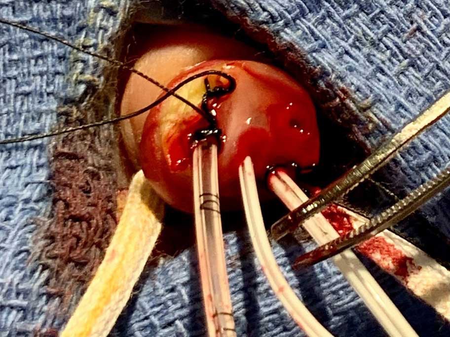 Four-vessel umbilical cord