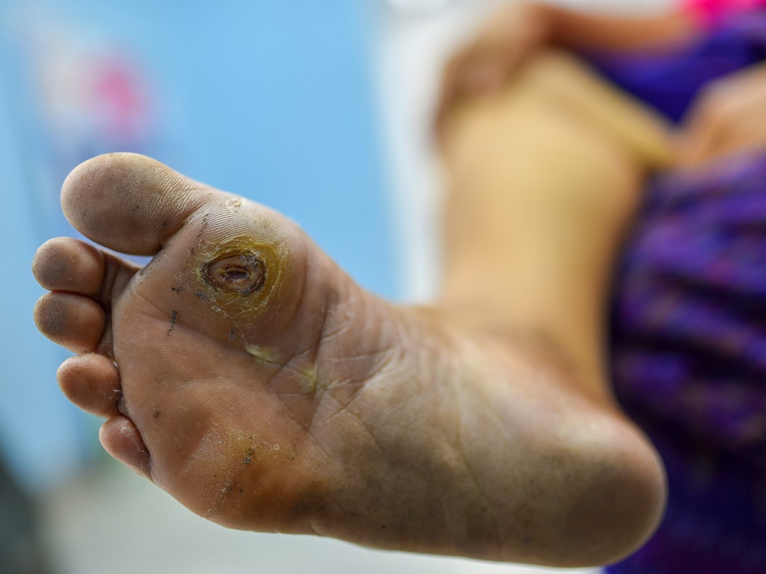 Foot ulcer
